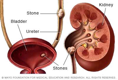 Cross section of kidney and kidney stones